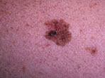 melanoma-piel